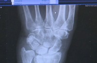 18 старозагорци с фрактури след падане от понеделник