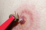 РЗИ регистрира заболял от  марсилска треска в Старозагорско