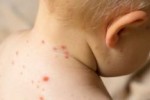 Няма регистрирани заболели от морбили в Старозагорско