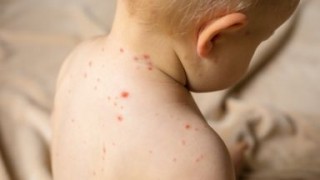 Няма регистрирани заболели от морбили в Старозагорско
