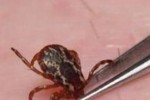 Заболял от Марсилска треска регистрираха в Стара Загора
