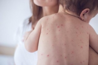 РЗИ – Стара Загора предприе превантивни мерки за недопускане на морбили в област Стара Загора